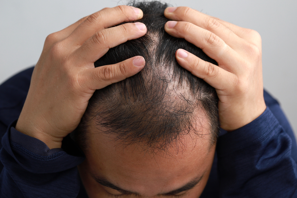 Chute de cheveux